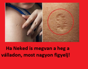Ha Neked is megvan a heg a válladon, most nagyon figyelj!